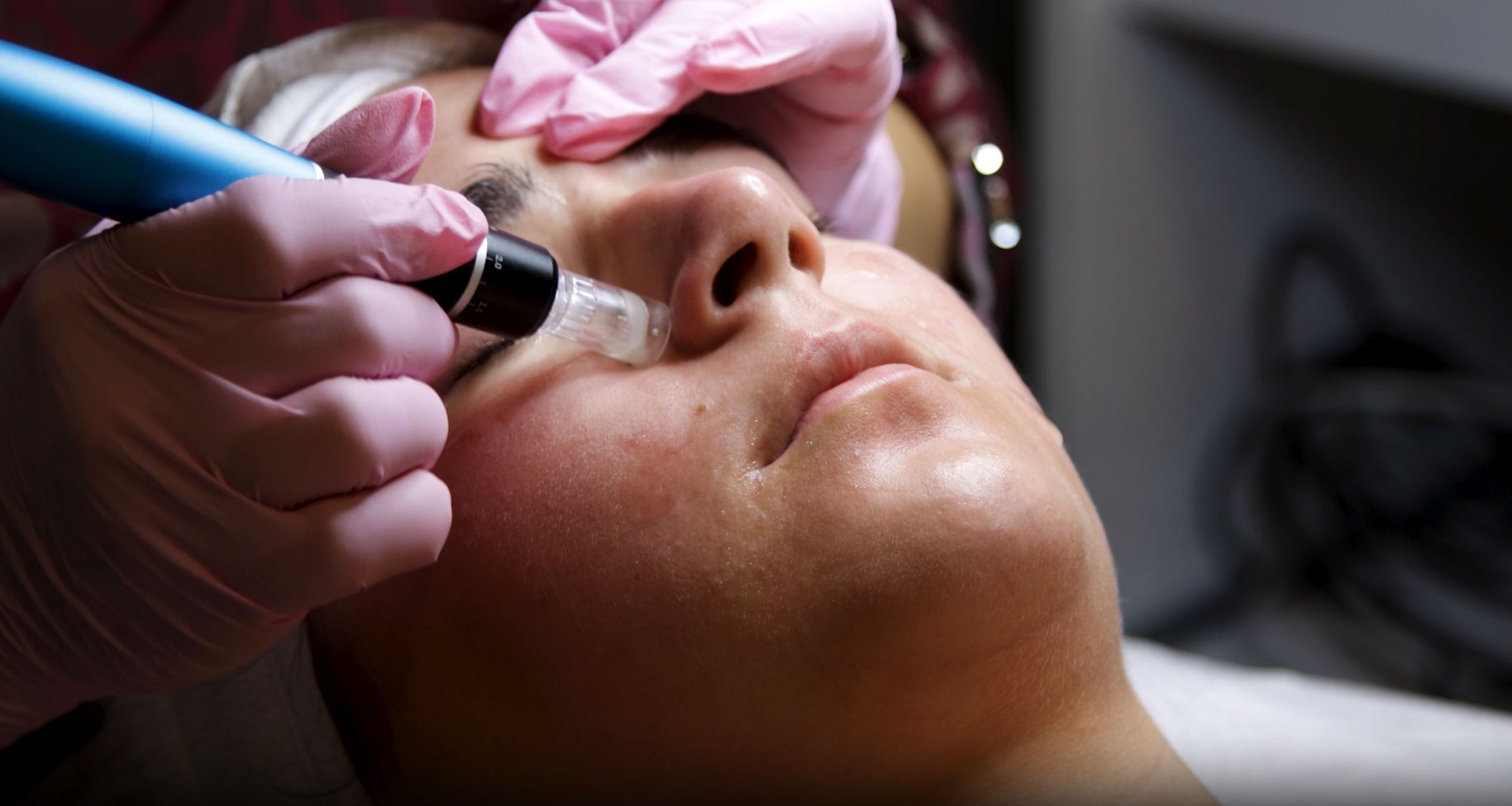Microneedling treatment (Dermapen treatment)