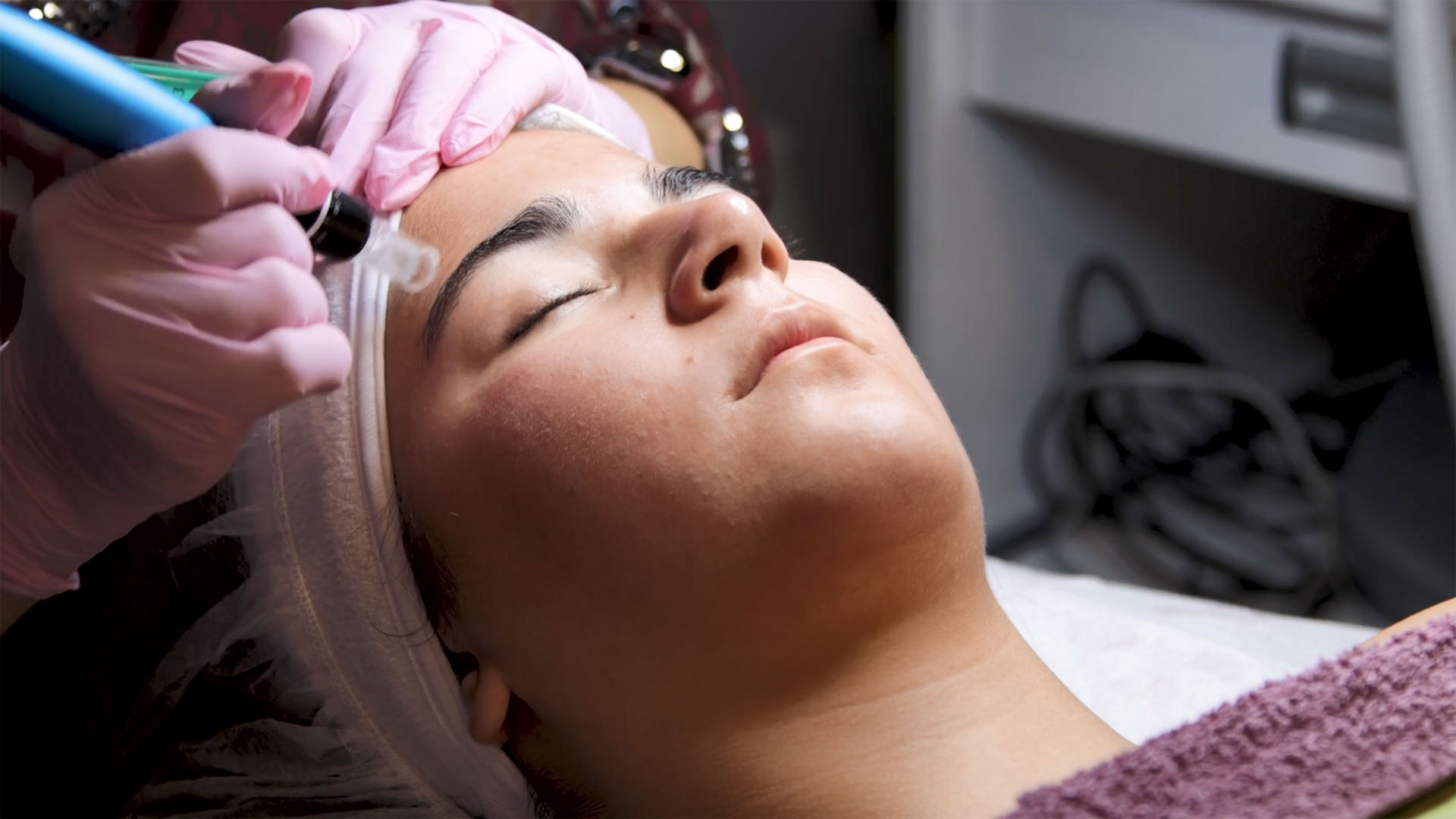 Microneedling treatment (Dermapen treatment) — изображение 3