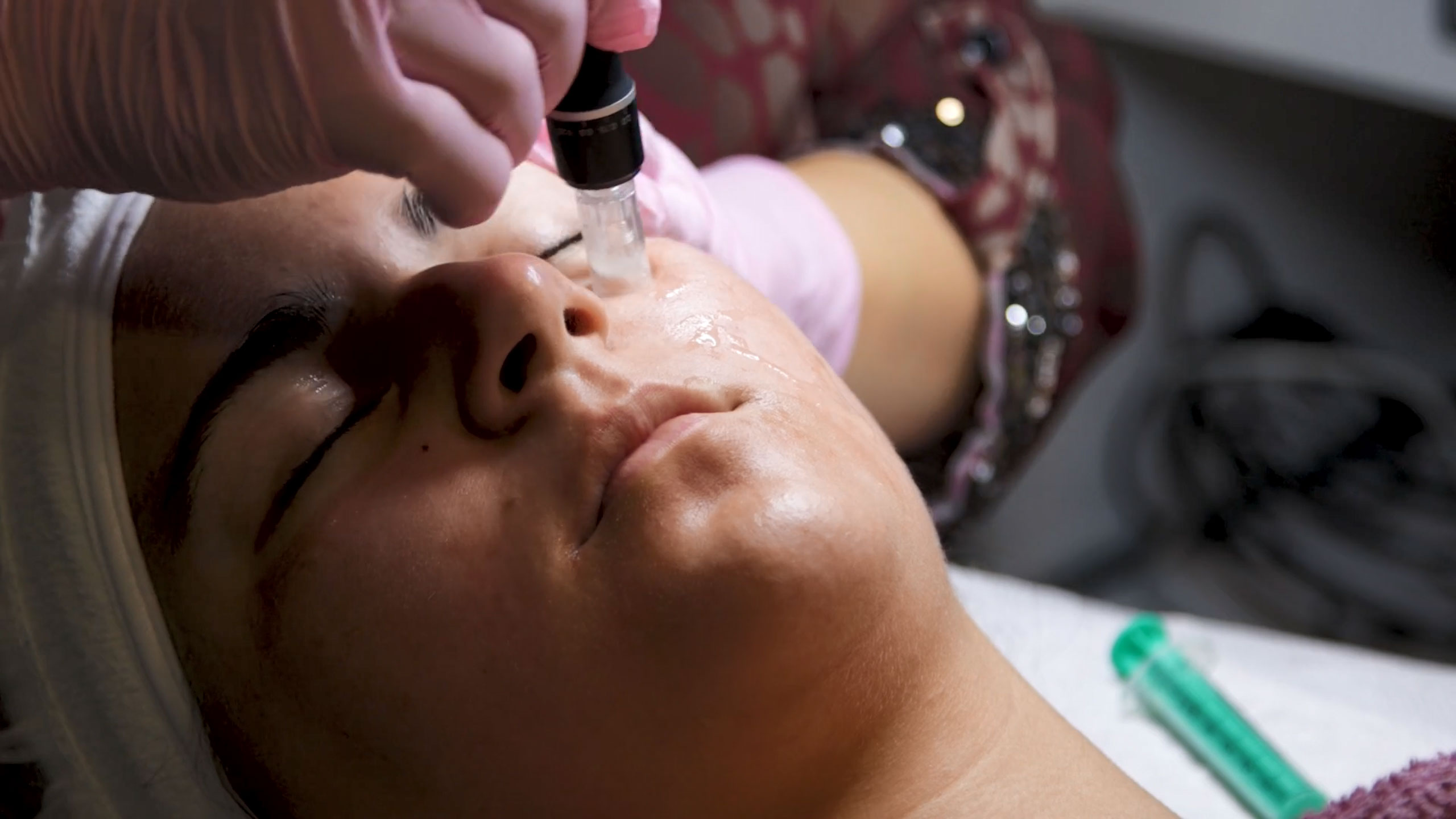 Microneedling treatment (Dermapen treatment) — изображение 4